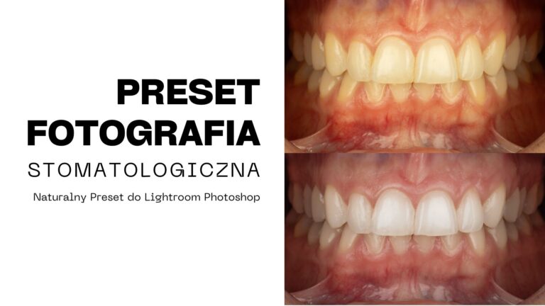 Autorski preset kolorystyczny do Lightrooma dla stomatologów, którzy oczekują pełnej powtarzalności i perfekcyjnej prezentacji swoich prac.